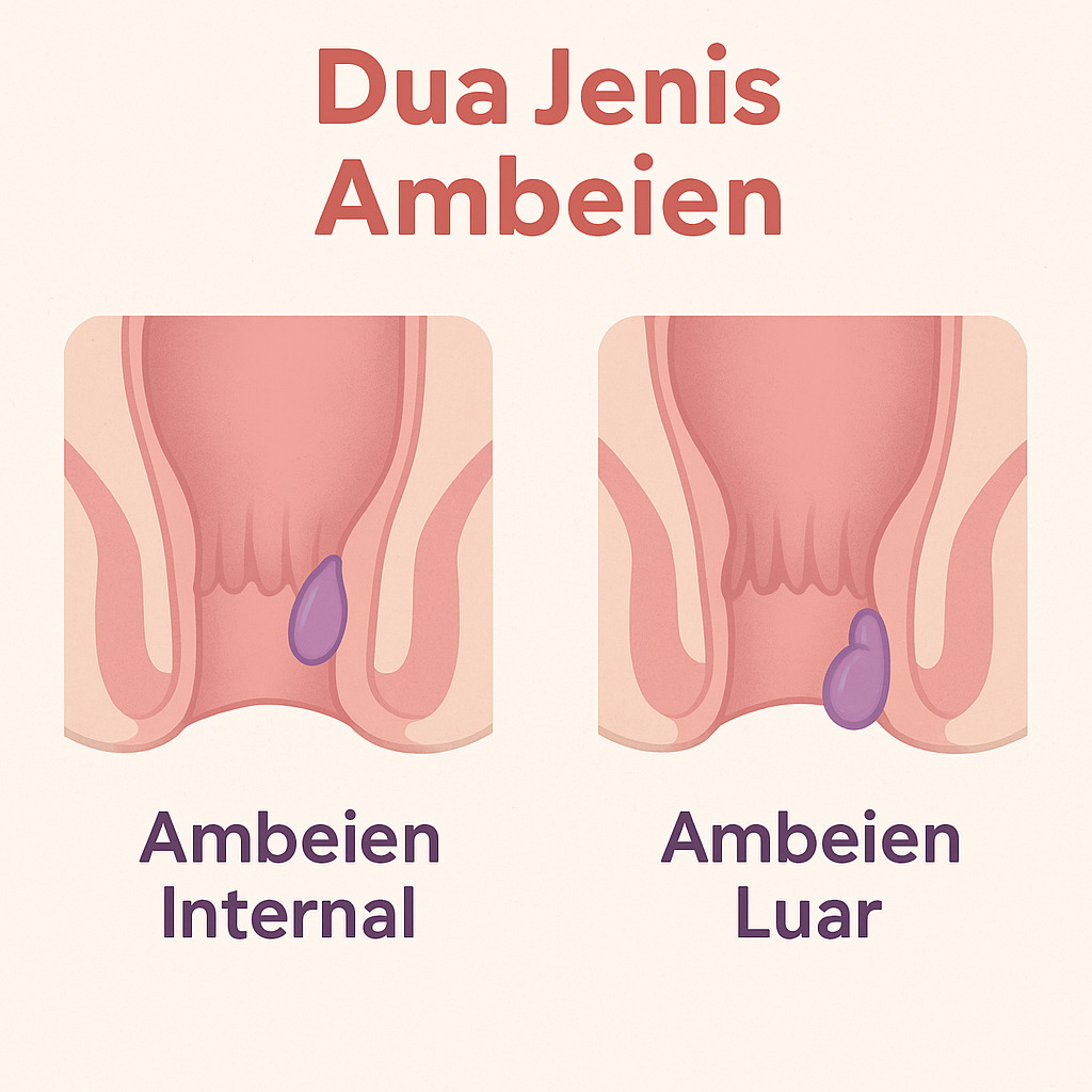 ilustrasi gambar dua jenis ambeien