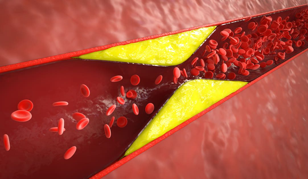 Kolesterol Tinggi: Penyebab, Gejala, dan Cara Alami Menurunkannya
