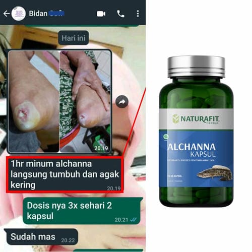 Testimoni Alchanna untuk luka diabetes