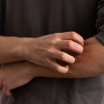 Gatal Gatal di Kulit: Penyebab, Ciri, dan Cara Mengatasinya