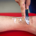 Luka Jahitan Lama Sembuh? Ini Penyebab dan Solusinya