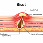 Bisul: Penyebab, Cara Mengobati & Cegah Kambuh