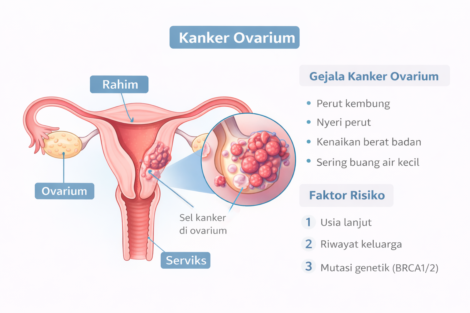 Ilustrasi kanker ovarium dan gejalanya