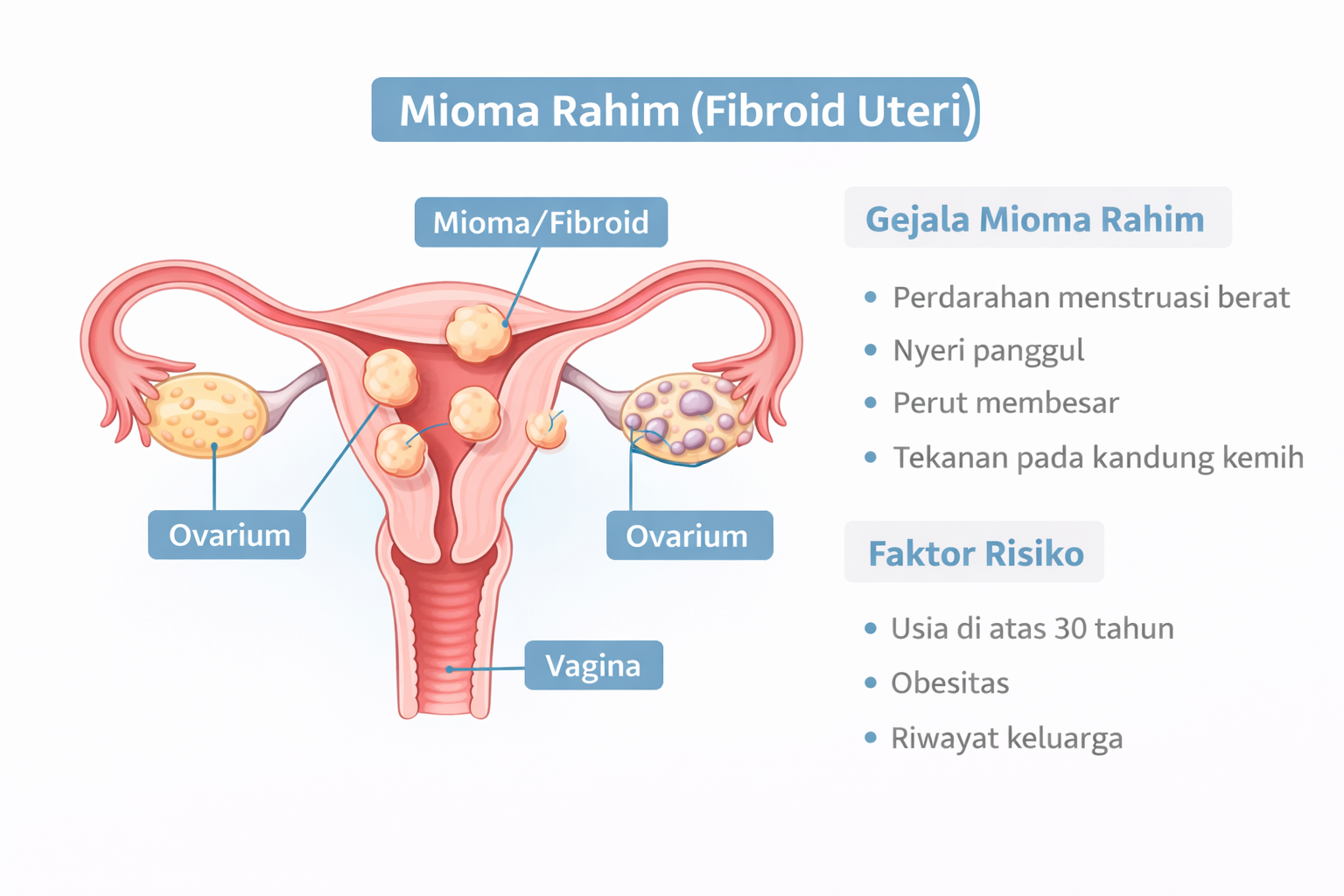 Mioma rahim gejala dan faktor risiko