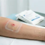 Obat untuk Luka Terbuka agar Cepat Kering
